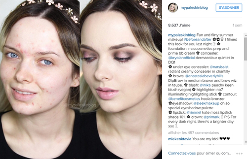 Harcelée à cause de son acné, une blogueuse beauté contre-attaque !