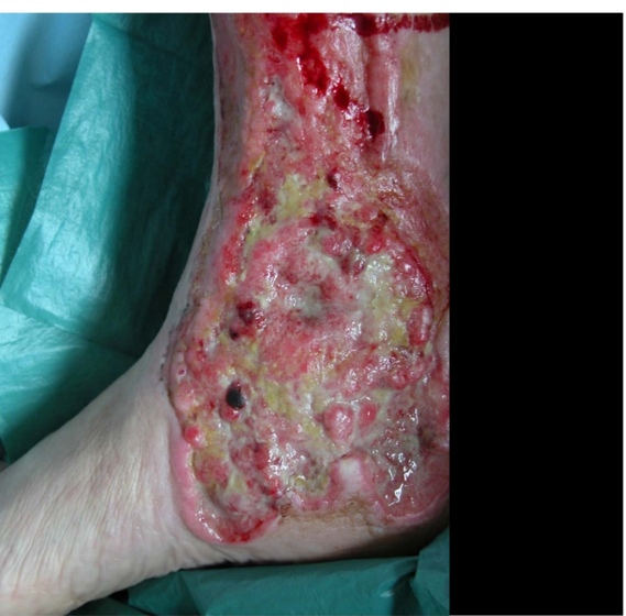 Prise en charge des ulcères variqueux - UNITE DE PHLEBOLOGIE Talia KHATI