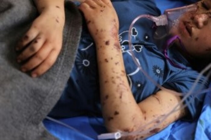 "Rattachez moi mes jambes" : l'effroi  des enfants amputés dans Gaza en guerre