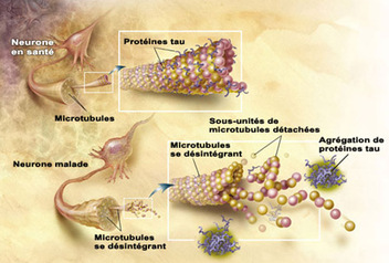 La maladie d'Alzheimer