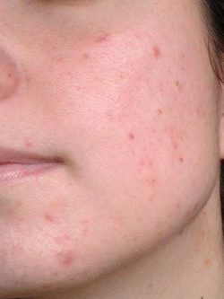 Février 2015, soins, routine, acné, visage