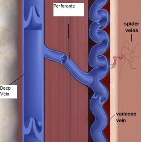 Résultat de recherche d'images pour "image saphène et perforantes"