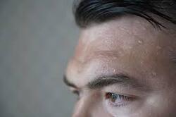 Transpiration après greffe de cheveux : quels sont les effets ?