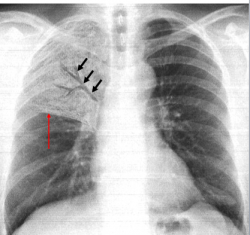 albuterol sulfate ventolin albuterol sulfate ventolin