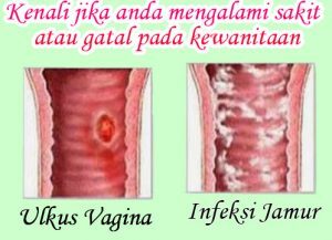 obat gatal jamur pada lubang vagina yang 3 hari sembuh