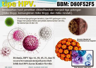 Obat Kutil Kelamin, Cara Mengobati Kutil Dikemaluan Kelamin Dari Rumah Sendiri, Dokter Obat Kutil Kelamin Terbukti Terbaik Dan Terpercaya Obat Kutil Kelamin, Cara Mengobati Kutil Dikemaluan Kelamin Dari Rumah Sendiri, Dokter Obat Kutil Kelamin Terbukti Terbaik Dan Terpercaya