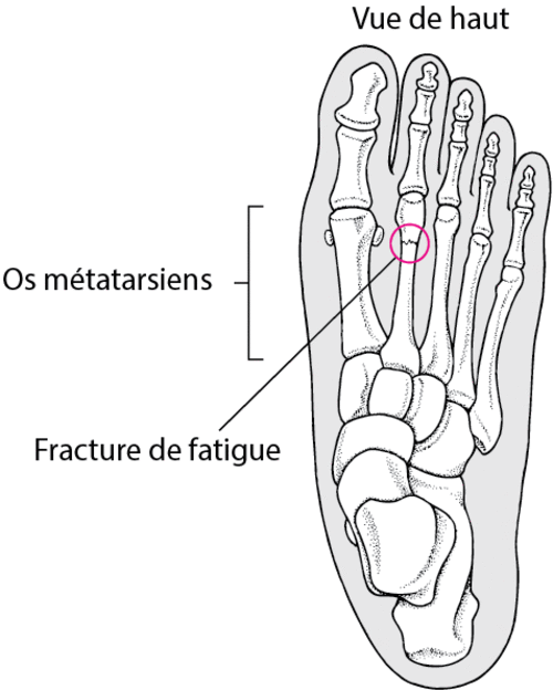 Fracture de fatigue du pied (os du milieu du pied, les métatarsiens).gif