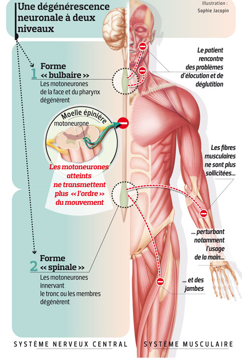 SLA - Schéma d'une dégénérescence neuronale à deux niveaux - une description textuelle suit SLA - Schéma d'une dégénérescence neuronale à deux niveaux - une description textuelle suit