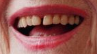 Les dents d'Arletty
