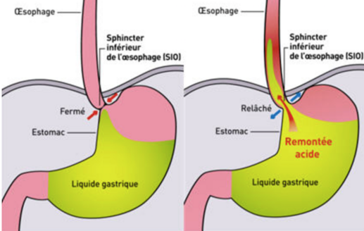 Le reflux gastro œsophagien - Bébé RGO : causes, symptômes et traitements