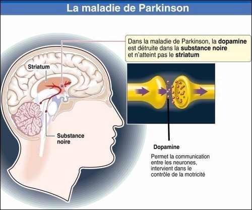 maladie de Parkinson
