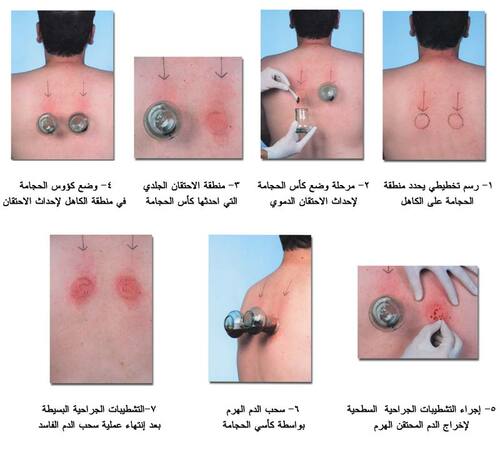 طريقة الحجامة بالصور