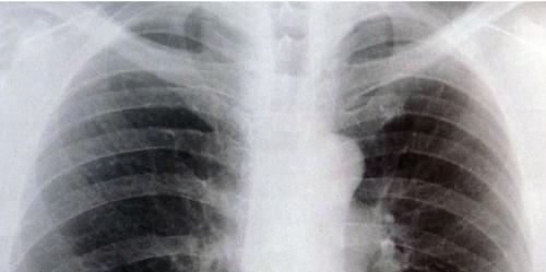 Chest X-rays Just before Surgery