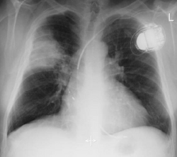 Item 86 - Infections broncho-pulmonaires