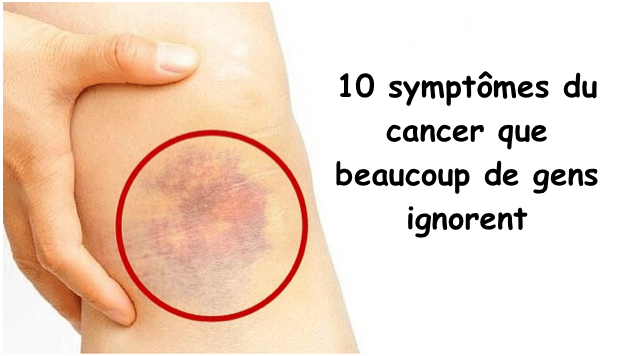 symptome cancer des os symptome cancer des os