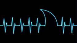 Electrocardiogramme - Cliquer pour agrandir