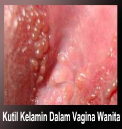 Nama salep kutil kelamin di apotik kimia umum sembuh mujarab