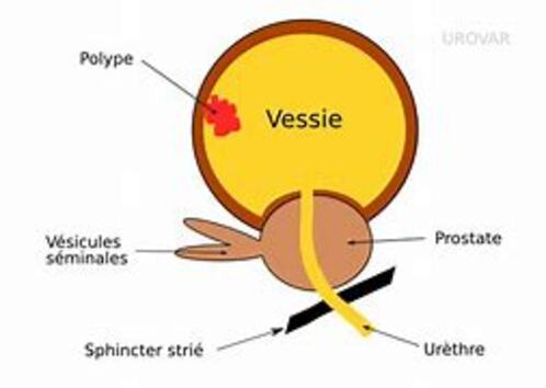 Résultat d’images pour Rtuv Vessie