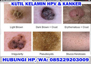 Obat Kutil Kelamin, Cara Mengobati Kutil Dikemaluan Kelamin Dari Rumah Sendiri, Dokter Obat Kutil Kelamin Terbukti Terbaik Dan Terpercaya Obat Kutil Kelamin, Cara Mengobati Kutil Dikemaluan Kelamin Dari Rumah Sendiri, Dokter Obat Kutil Kelamin Terbukti Terbaik Dan Terpercaya