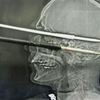 Un homme se tire un harpon accidentellement dans la tête !
