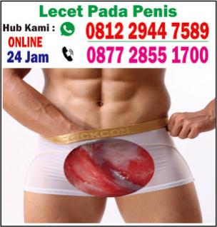 obat lecet pada penis akibat hubungan seks http://klinikonlinedenature.com/