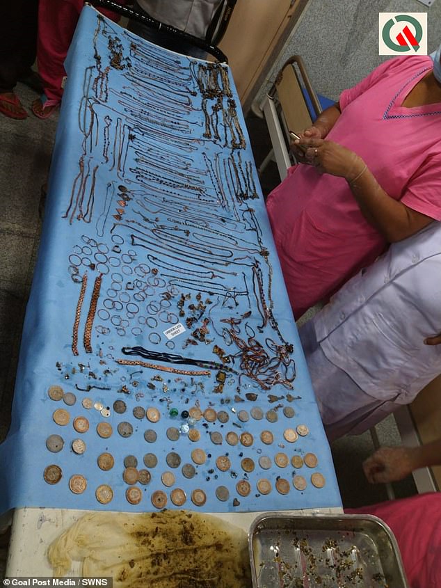 During surgery, doctors removed 69 chains, 80 earrings, 46 coins, eight lockets, 11 nose rings, four keys, five anklets and one watch dial from her abdomen