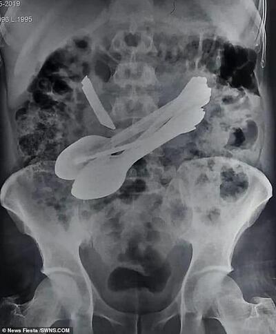 Une opération d'urgence a été pratiquée lors de la radiographie et a révélé qu'il y avait huit cuillères (photo) et qu'un couteau avait perforé un trou dans le ventre de l'homme.