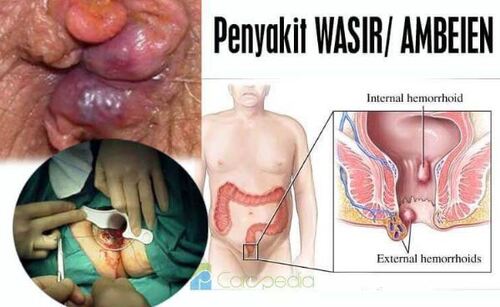 Tips Mengobati Ambeien