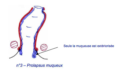 Prolapsus-muqueux