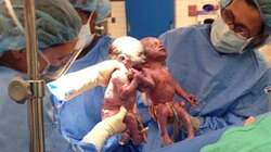 Des jumelles naissent en se tenant par la main 