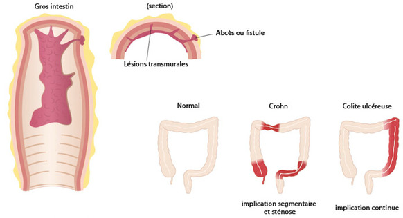 maladie de crohn