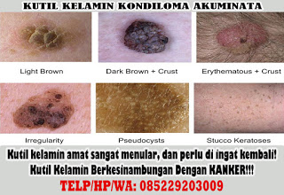 Obat Kutil Kelamin Obat Kutil Kelamin