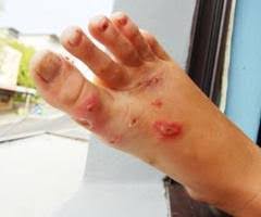 Nama Obat ampuh untuk Gatal Eksim kering Menahun di kaki Nama Obat ampuh untuk Gatal Eksim kering Menahun di kaki