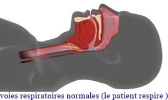 Syndrome d'apnées du sommeil (1/2)