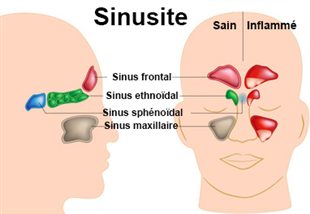 Sinusite