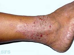 Kulit kering bersisik menahun dan terasa gatal gatal di kaki Kulit kering bersisik menahun dan terasa gatal gatal di kaki