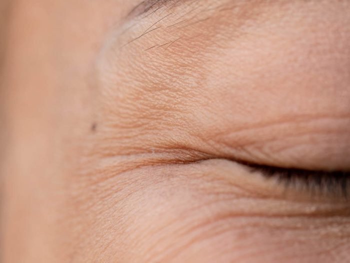 Les rides du visage peuvent être liées au cancer de la peau.