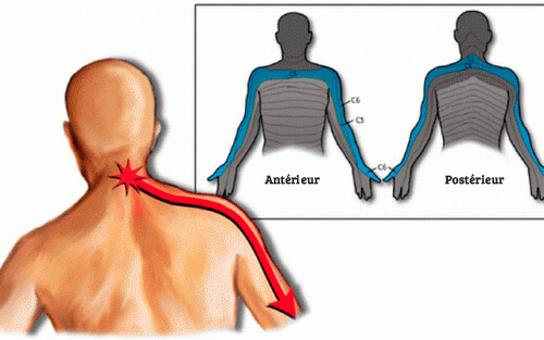 cervicobrachialgie