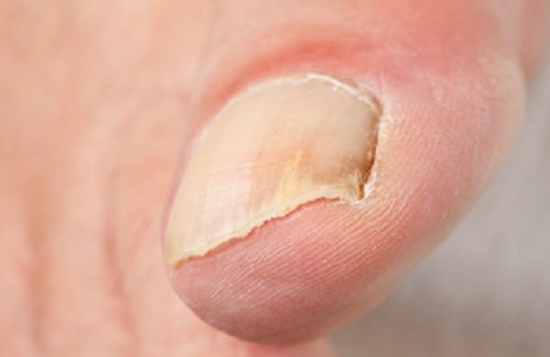 maladie des ongles de pieds photos maladie des ongles de pieds photos