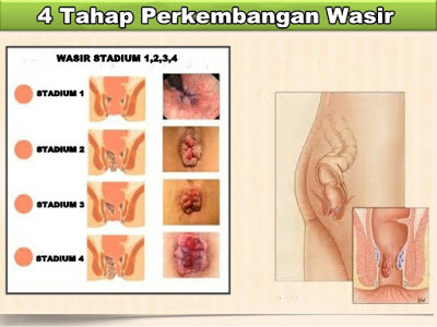 APOTIK YANG MENYEDIAKAN OBAT WASIR BERDARAH DI DAERAH MAKASSAR