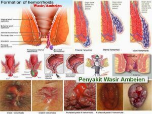 Obat sakit saat buang air besar di apotik