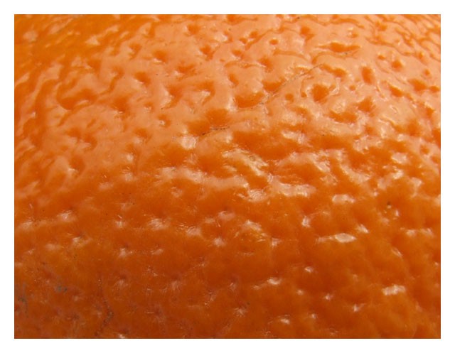 Celluilte dite peau d' orange