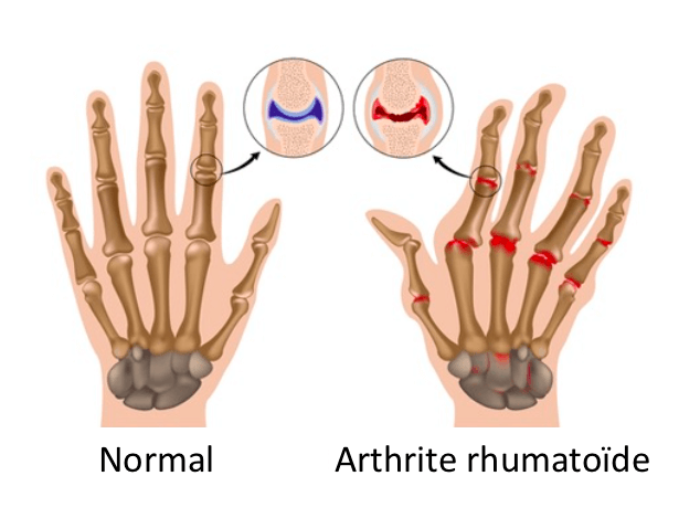 arthrite rhumatoide