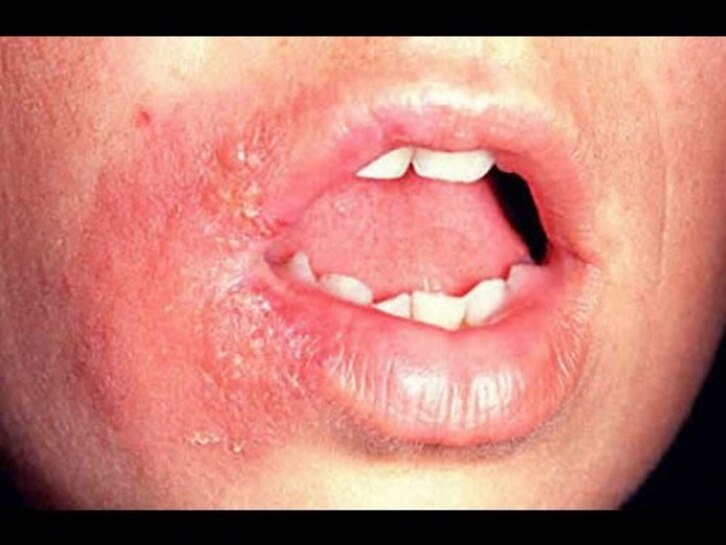 Is a fever blister a cold sore?