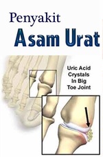 Cara mengobati asam urat pada lutut secara alami