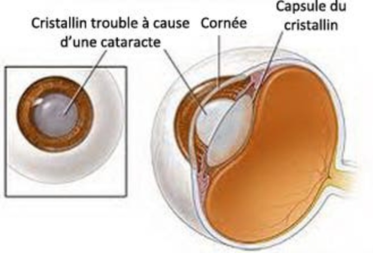 Il est important de lutter contre la cataracte.