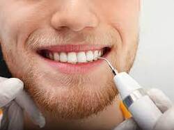 Nettoyage dentaire professionnel