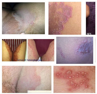 obat penghilang gatal jamur di kulit selangkangan dan sekitar kemaluan wanita
