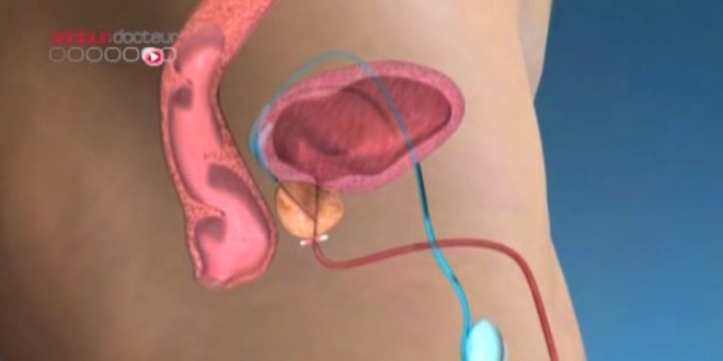 Cancer de la prostate et vasectomie : le lien remis en question Cancer de la prostate et vasectomie : le lien remis en question