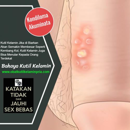 CARA MENGHILANGKAN KUTIL KELAMIN MENGGUNAKAN BAWANG PUTIH